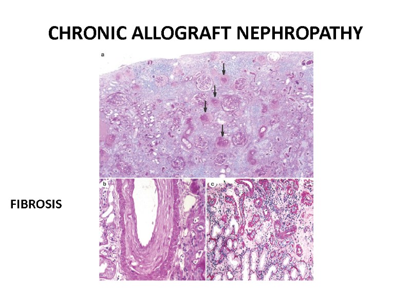 CHRONIC ALLOGRAFT NEPHROPATHY FIBROSIS